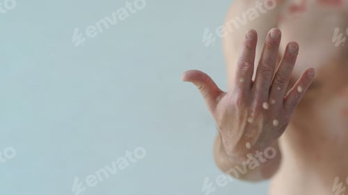 Preview: Male hand affected by blistering rash because of monkeypox or other viral infection on green