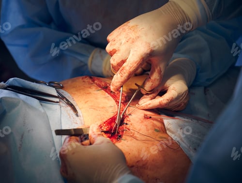 Preview: Surgical Procedure with Instruments in Hospital Setting