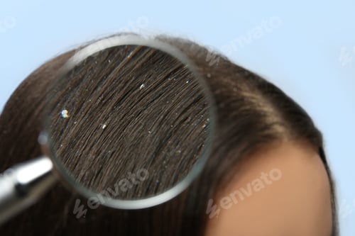 Preview: Closeup of woman with dandruff in her hair on color background, view through magnifying glass