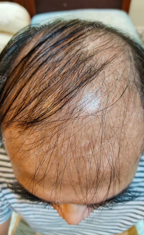 Vista previa: Closeup of man with hair loss. Overhead shot of head.