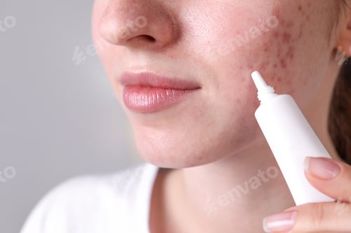 Preview: Woman with acne problem applying cream at home, closeup