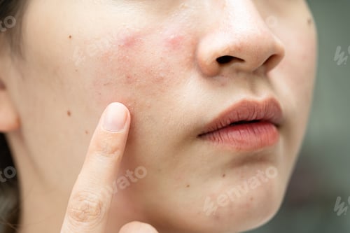 Preview: Asian young with pimple, acne, scar on skin, facial problem.