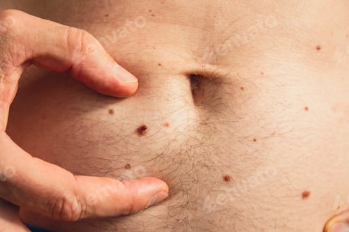Preview: Male hand showing birthmarks on skin body stomach part. Close up detail of the bare skin. Health