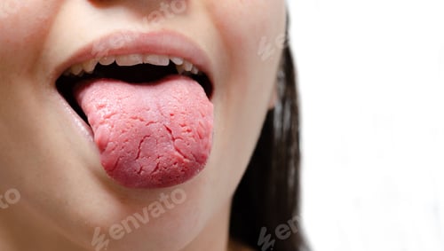 Preview: Tongue of a young Caucasian woman with benign migratory glossitis, candidiasis.