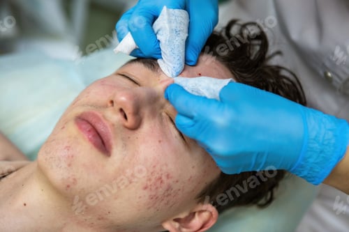 Preview: Treatment of acne in adolescents. Facial peeling to fight acne on the face