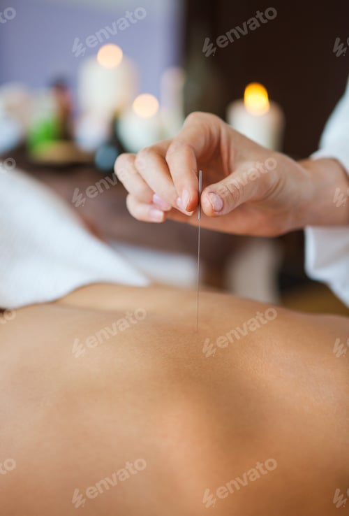 Preview: Close up of a hand placing acupuncture needle on back of a woman
