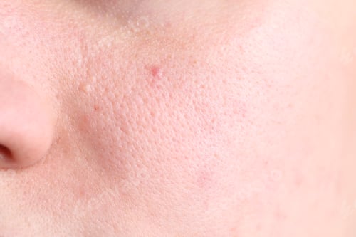 Preview: Texture of skin with enlarged pores as background, closeup
