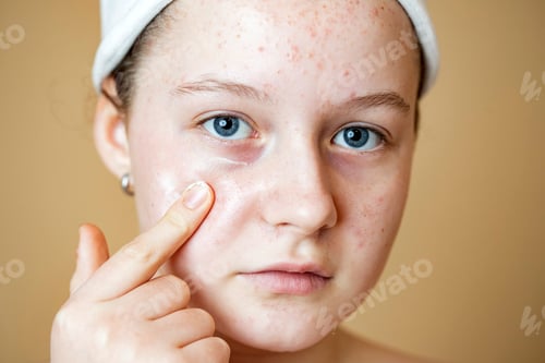 Preview: Problematic skin. Acne and red festering pimples on the face of a young girl using cream.