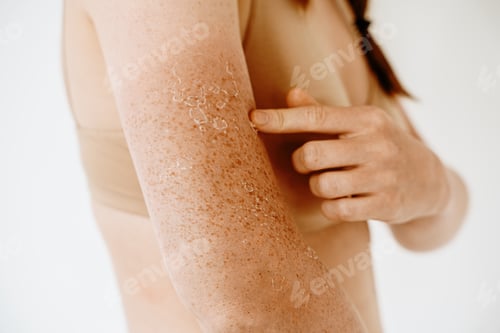 Preview: Peeling skin after sunburn, dermatology problems