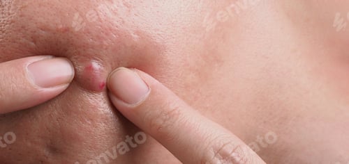 Preview: Big Acne Cyst Abscess or Ulcer Swollen area within face skin tissue.