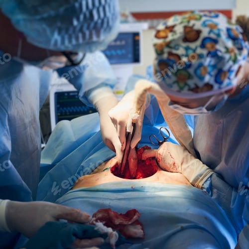Preview: Medical team doing abdominoplasty or tummy tuck surgery in clinic.