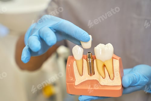 Preview: Plastic prop of teeth implant being shown by dentist