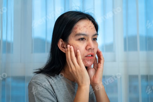 Preview: Acne on face because the disorders of sebaceous glands productions. Acne or a Cosmetic