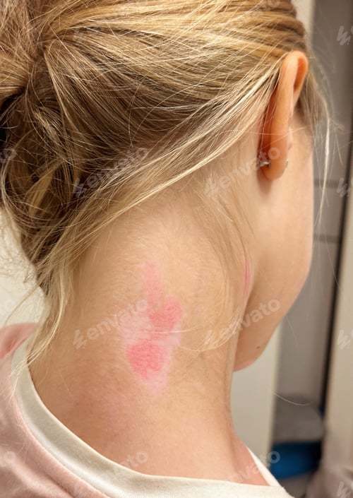 Preview: little caucasian girl suffering from vitiligo disorder. person with skin condition that causes loss