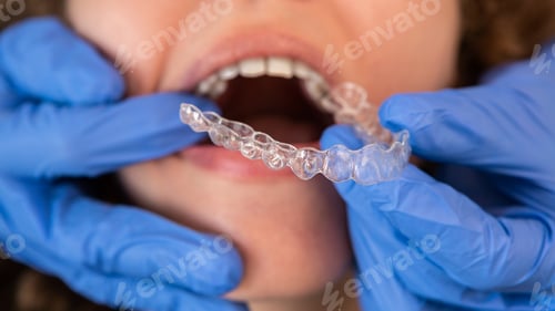 Preview: Orthodontic specialist adjusting and placing invisible aligners on woman