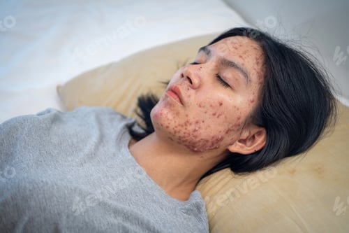 Preview: Pillows Cause Acne, Acne on Your face might be suffering when you rest your head upon