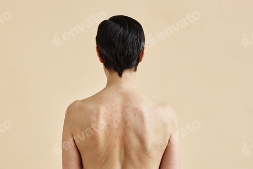 Preview: Woman with rash spots on bare back