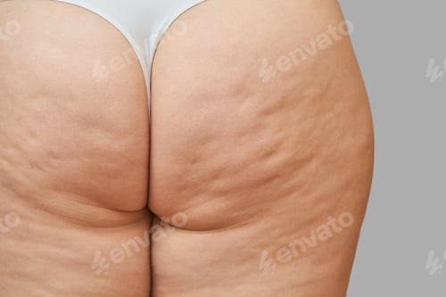 Preview: Close-up of female adult caucasian skin with visible cellulite on thighs