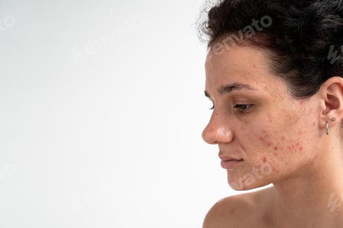 Preview: Close-up skin texture with red pimples, irritation and clogged pores