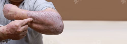 Preview: Banner Acute form of psoriasis skin. Male showing arm with cracked, hard, horny, flaky skin.