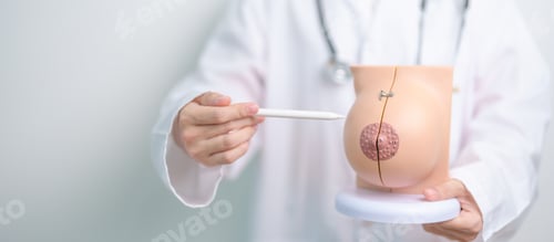 Preview: Doctor holding Breast Anatomy model. Breast Augmentation