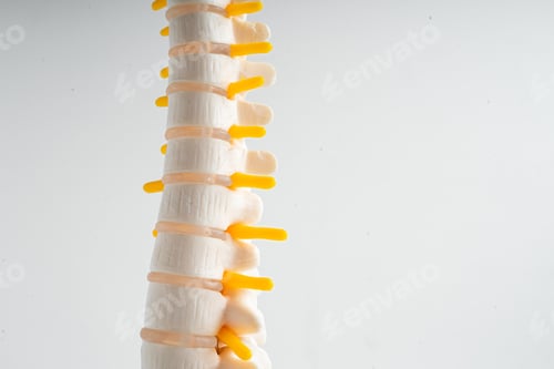 Preview: Lumbar spine displaced herniated disc fragment, spinal nerve and bone. Model for treatment medical