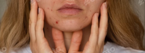 Preview: Unrecognizable woman showing her acne on face. Banner Close-up acne on woman's face with rash skin