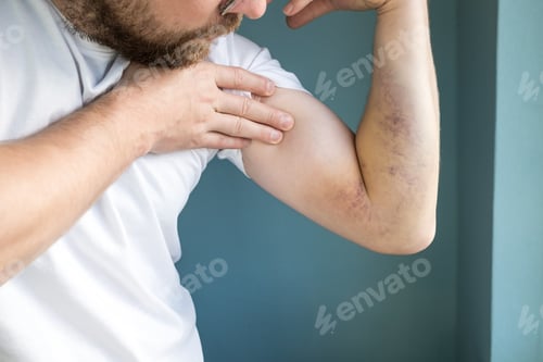 Preview: Man examines a large bruise on his arm caused by an injury. Close-up.