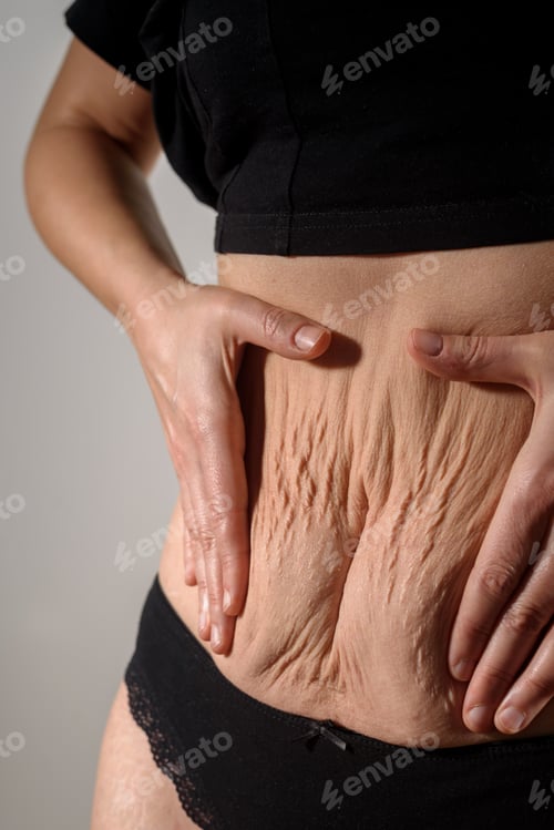 Preview: Woman belly with stretch marks and scars