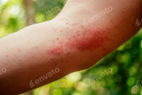 Preview: Woman with itching from biting insect in body in tropical jungle forest