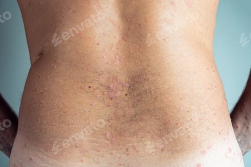 Preview: Back view of bare back of unrecognizable man showing scaly flaky affected skin with blemishes suffer