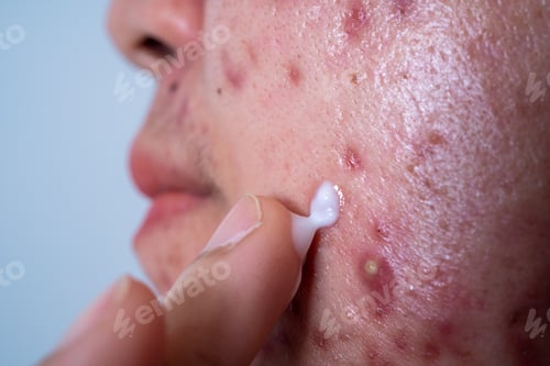 Preview: Acne on face because the disorders of sebaceous glands productions. Acne or a Cosmetic Allergy.