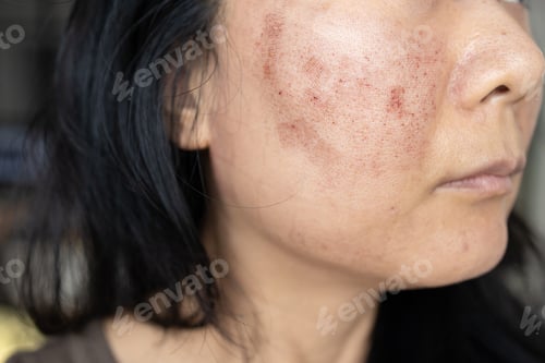Preview: A face of Asian woman who had facial skin treatment by Co2 laser to treat her Acne Scars to get face