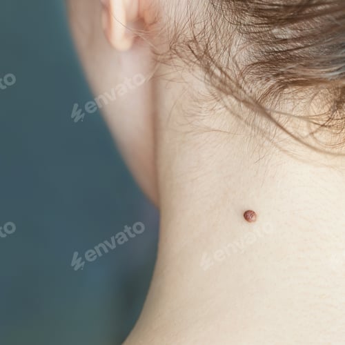 Preview: Close-up of a mole on the neck of a caucasian female adult with brown hair