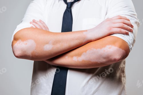 Preview: Close up of a human hand with symmetrical spots of vitiligo disease on the skin.