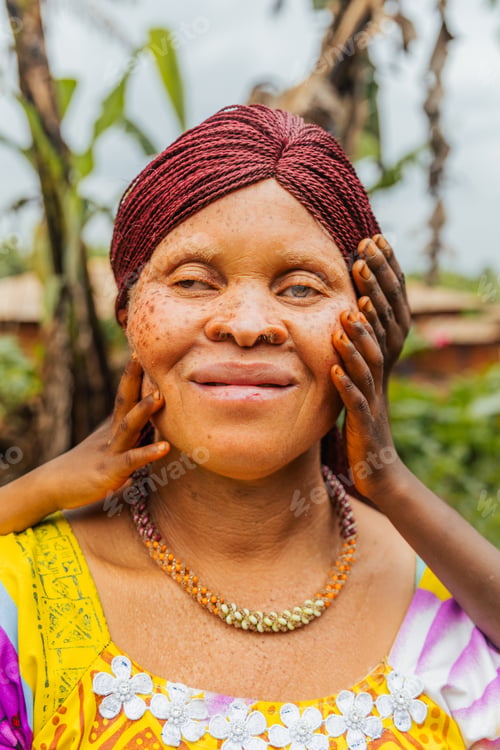 Preview: Portrait of an albino African woman touched by children's hands, concept of albinism in Africa
