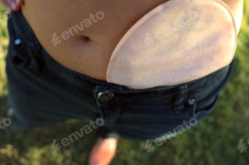 Preview: A woman with a colostomy bag on her belly