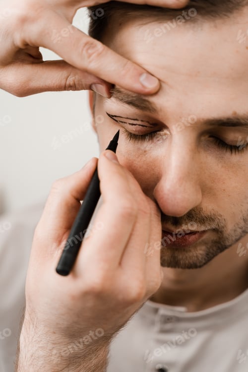Preview: Preoperative male eyelid markings drawn by surgeon before cosmetic eye correction