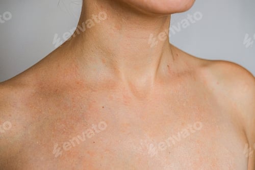 Preview: Psoriasis Skin Disease Is A Dermatic Problem, Red Allergic Skin Rash.