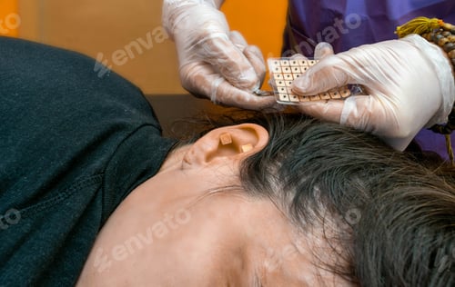 Preview: Auriculotherapy by using needles and pressure points