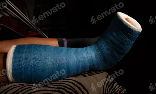 Preview: Closeup of a person's leg in a cast due to a fracture.