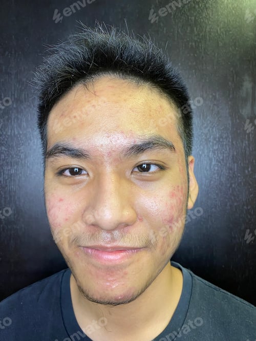 Vista previa: Portrait of an Asian teenager with serious acne problems and deep scarring