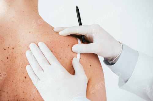 Preview: cropped view of dermatologist in latex gloves holding marker pen near woman with melanoma isolated