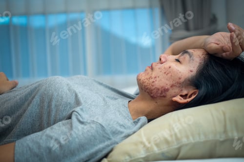 Preview: Acne on face because the disorders of sebaceous glands productions. Acne or a Cosmetic Allergy.