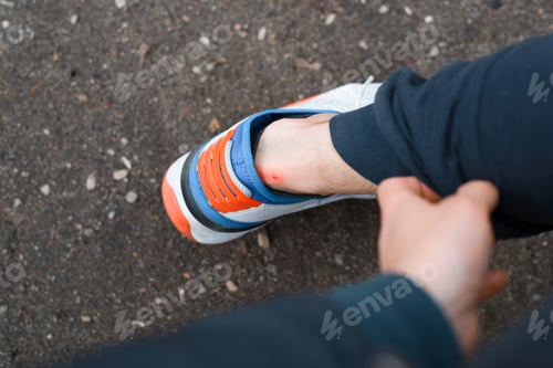 Preview: Bloody callus from a shoe. Man showing a leg, ankle with a corn, close-up. Selective focus