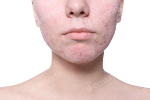 Preview: Young woman with acne problem on white background
