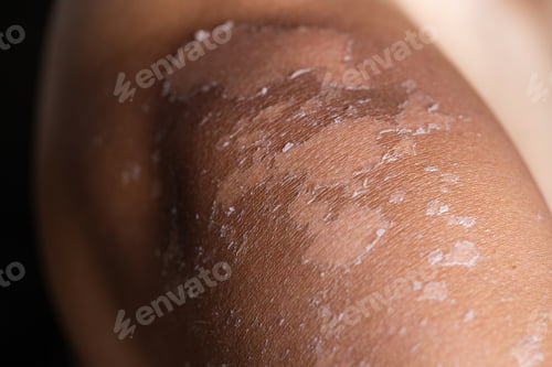 Preview: Man suffer from sunburned skin close up