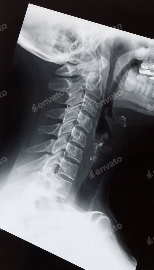 Preview: Medical X ray of a female neck, jaw and spine