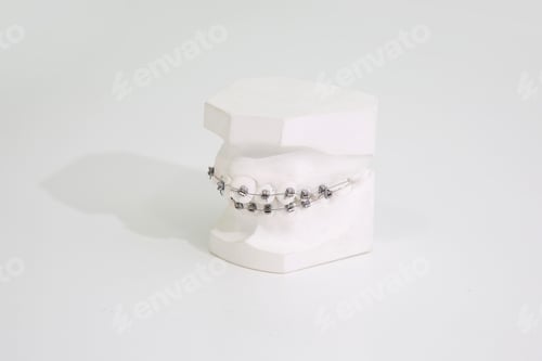 Preview: orthodontic model in plaster with brackets