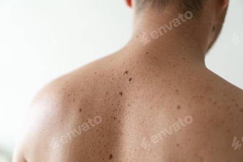 Preview: Close up detail of the bare skin on a man back with scattered moles and freckles.